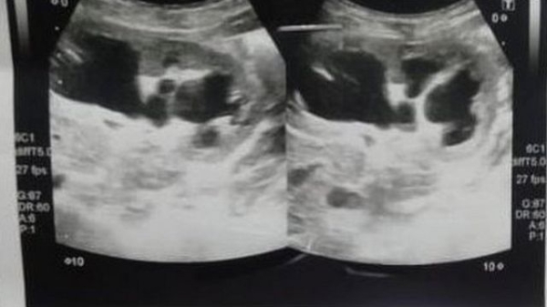 An ultrasound of baby Shazia's abdomen
